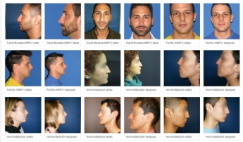 Rinomodel advierte que la cirugía estética nos puede convertir en otra persona