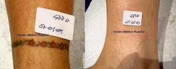 Las razones laborales son el principal motivo para eliminar tatuajes