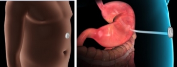 Método Aspire, novedoso tratamiento para la obesidad sin cirugía