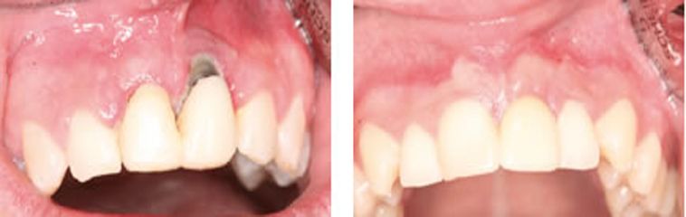Foto de Duración de los implantes dentales