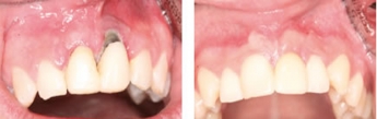 ¿Cuánto dura un implante dental?