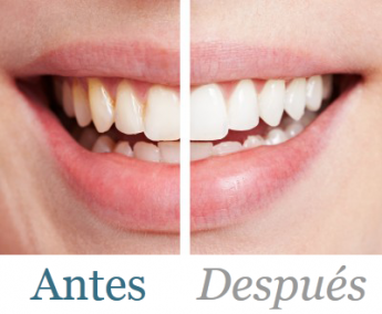 Ventajas del blanqueamiento dental