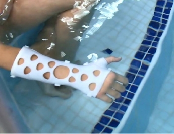 Las férulas en 3D permiten recuperarse de una fractura sin renunciar al verano