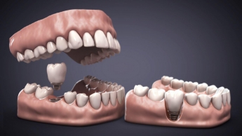 Recreación dental en 3D para profesionales, eventos y congresos y tutorías 3D en odontología, por Pixelon