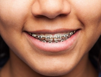 Coinsol Dental, profesionales de la ortodoncia en Sevilla: sobre unos dientes bien colocados  
