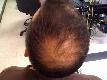 Un estudio de una enfermedad de la piel revela una de las causas de la alopecia