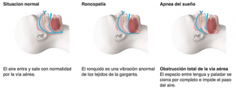 Noticias Bienestar | Diagnóstico apnea del sueño