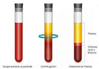El traumatólogo García Renedo explica el plasma rico en factores de crecimiento contra la artrosis