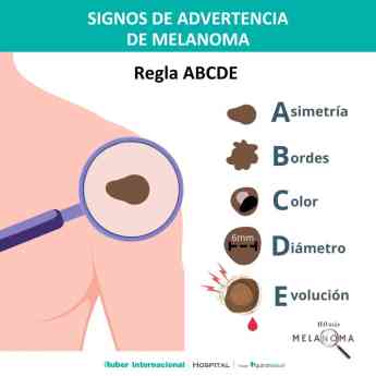 Noticias Nacional | Regla melanoma: ABCDE