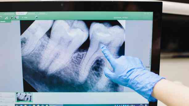 "Cada vez hay más evidencia de que la enfermedad periodontal, una inflamación crónica de las encías, puede estar relacionada con un mayor riesgo de sufrir infartos o accidentes cardiovasculares", doctor Carlos Mederos
