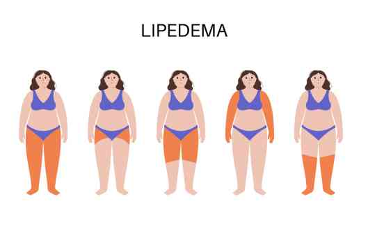 Dolor, hinchazón y dificultad para caminar: así impacta el lipedema en la vida de las mujeres