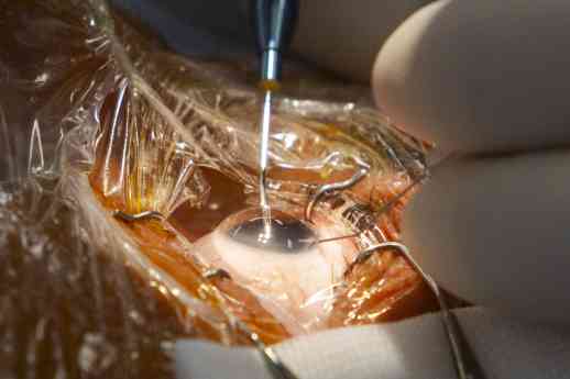 El codirector de FacoElche se somete en directo a la implantación bilateral de una lente diseñada con IA
