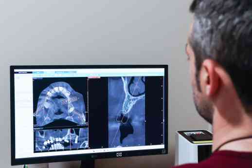 IOCantábrico analiza el papel de los implantes dentales en Gijón como solución avanzada para recuperar la sonrisa