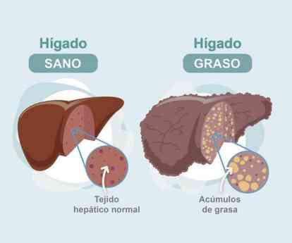 Dr. Juan Arenas, jefe servicio Aparato Digestivo:"Hoy disponemos de un nuevo medio no invasivo para detectar la fibrosis hepática"