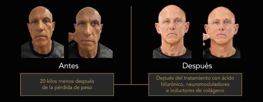 La otra cara del éxito de los GLP-1: el nuevo reto de la medicina estética